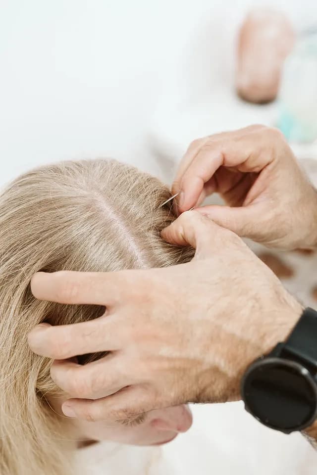 YNSA Scalp Acupuncture